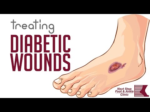Bmj best practice diabetic foot