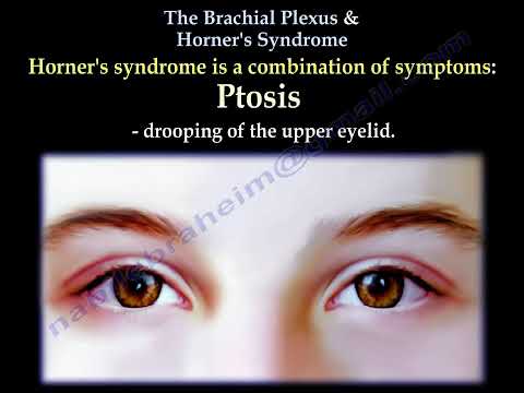Brachial Plexus Injury and Horner Syndrome