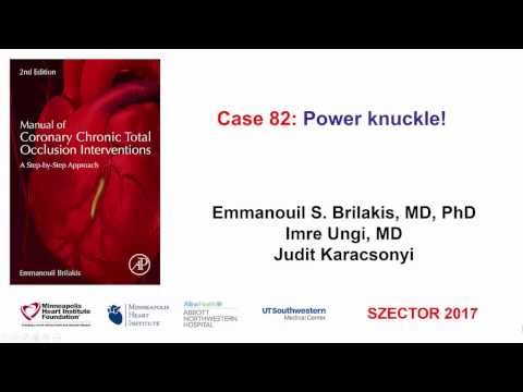Case 82: Manual of CTO Interventions: BASE (balloon-assisted subintimal entry)