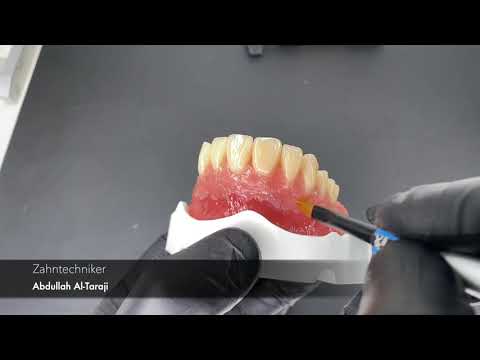 Composite Schichtung Kunstzahnwerk Wettbewerb 2021