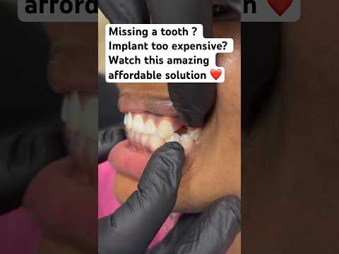 Missing tooth ? Implant too pricey? Watch this simple affordable amazing solution ❤️!