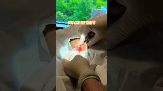 Massive Infected Cyst Explodes! Watch This Jaw-Dropping Extraction 🤯🔥 #DermPopper