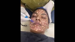 BB glow treatment
