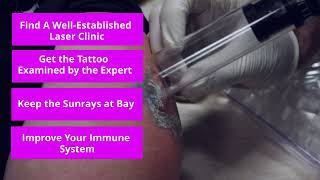 How To Prepare For Your First Laser Tattoo Removal