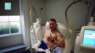 CoolSculpting Patient Review Dean | Fat Freezing treatment