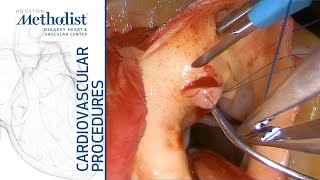 Download Lagu Unroofing of Anomalous Right Coronary Artery (Ramchandani, MD; Spooner, MD; Al Abri, MD; Zubair, MD) Thumbnail