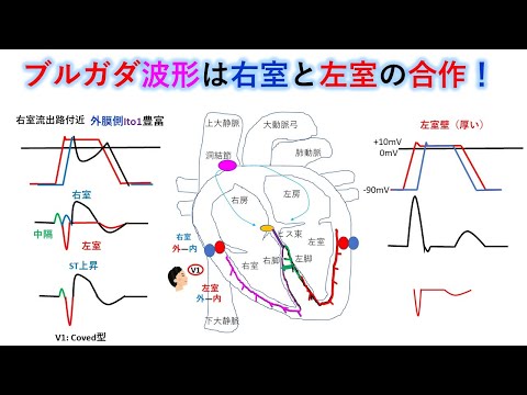 ブルガダ症候群について詳しく解説