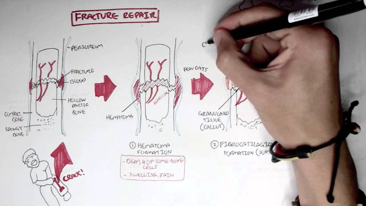 Bone Fracture - Types, Fracture Repair and Osteomyelitis