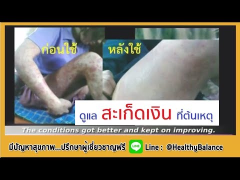 โดยเฉพาะอย่างยิ่งโรคสะเก็ดเงินอาหาร รูปภาพของโรคสะเก็ดเงิน