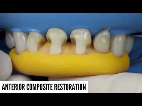 Anterior Composite Restoration