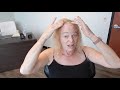 Watch This Video MTF Feminization Hair Transplant Procedure Day Video Hair Clinics In Fort Myers