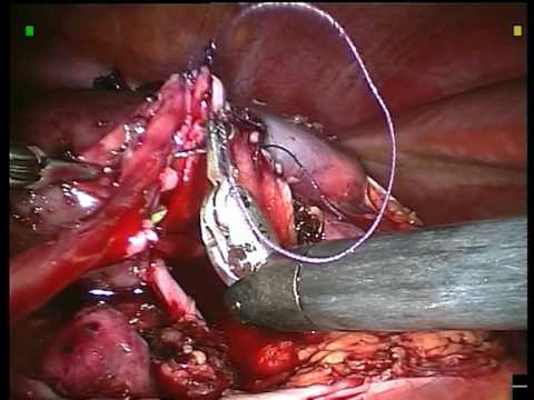 Agopuntura per osteocondrosi lombare E danneggiato larticolazione del mignolo