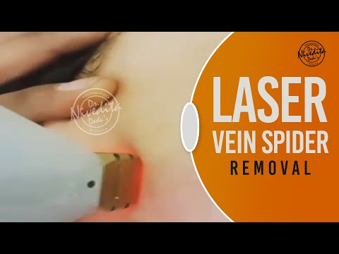 Spider Veins Treatment | Laser Treatment