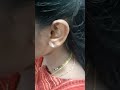 Earlobe Treatment without stitches🤩🤩