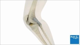 How knee arthroscopy is carried out