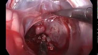 CHIRURGIE ENDOSCOPICA TRANSCRANIANA - NEUROENDOSCOPIE - TUM. VENTRICUL 4, pacient in varsta de 2 ani