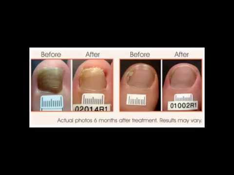 Lunas kuko halamang-singaw sa mga kamay ng isang listahan ng presyo Calamus ugat bilang isang lunas para fungus