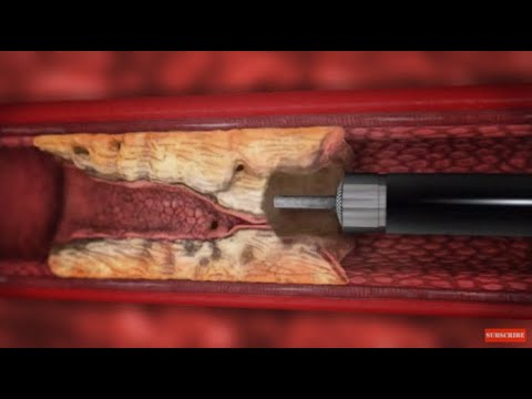 Turbo-Elite laser atherectomy animation