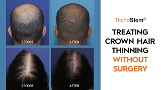 How Crown Hair Loss can be Treated for Thicker Hair Growth