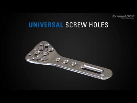 OsteoMed ExtremiLOCK Wrist Plating System