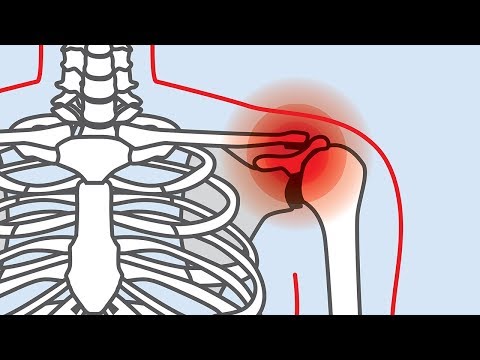 7 Natürliche Behandlungsmöglichkeiten bei Rotatorenmanschettenschmerzen!