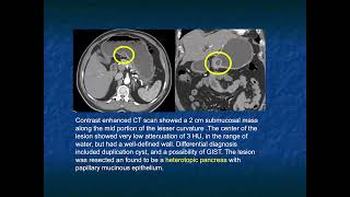 CT of Benign Polypoid Gastric Masses: Pearls, Pitfalls and  Differential Diagnosis - Part 2