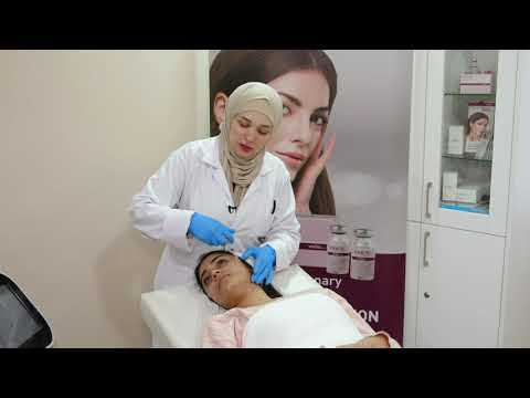 PRX -T33 The Smart peel with Dr  Hiba Zaitoun at Prima laser clinic Khalda Amman Jordan