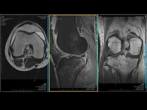 Artroza simptomelor costale ale articulațiilor transversale
