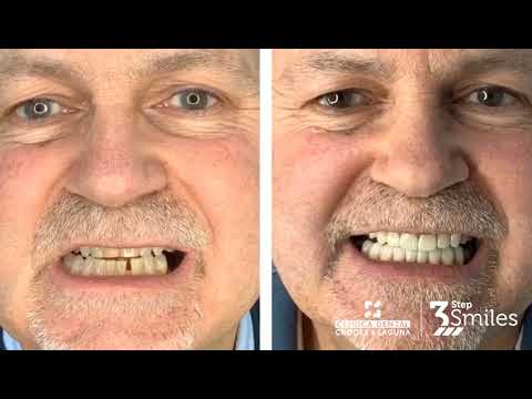 Restoration of dental wear caused by Bruxism - Porcelain Veneers