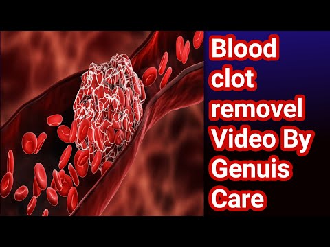 Heart Treatment -  Blood clot removel Video By Genuis Care  #English