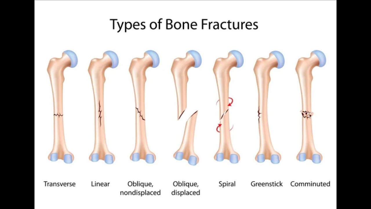 Fracture management in Marathi (फ्रॅक्चर चे उपचार)