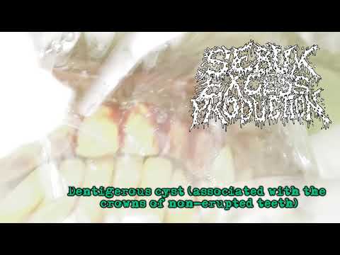 Sebum Excess Production - Dentigerous Cyst [VIDEO-CLIP] (2017 - Goregrind / Noisegrind)