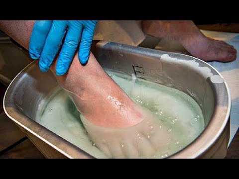 Die Behandlung der Nägel in lipezke Gribok die Füsse tatsächlich zu heilen