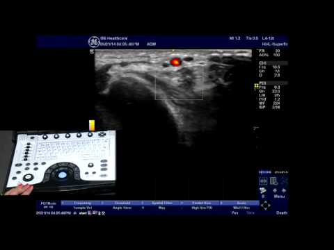 NextGen LOGIQ e: PDI