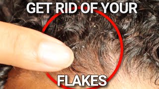 Why your scalp is flaky and HOW to FIX it