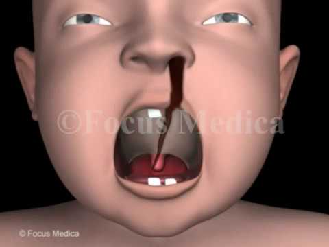 Cleft palate - Head & Neck - YouTube