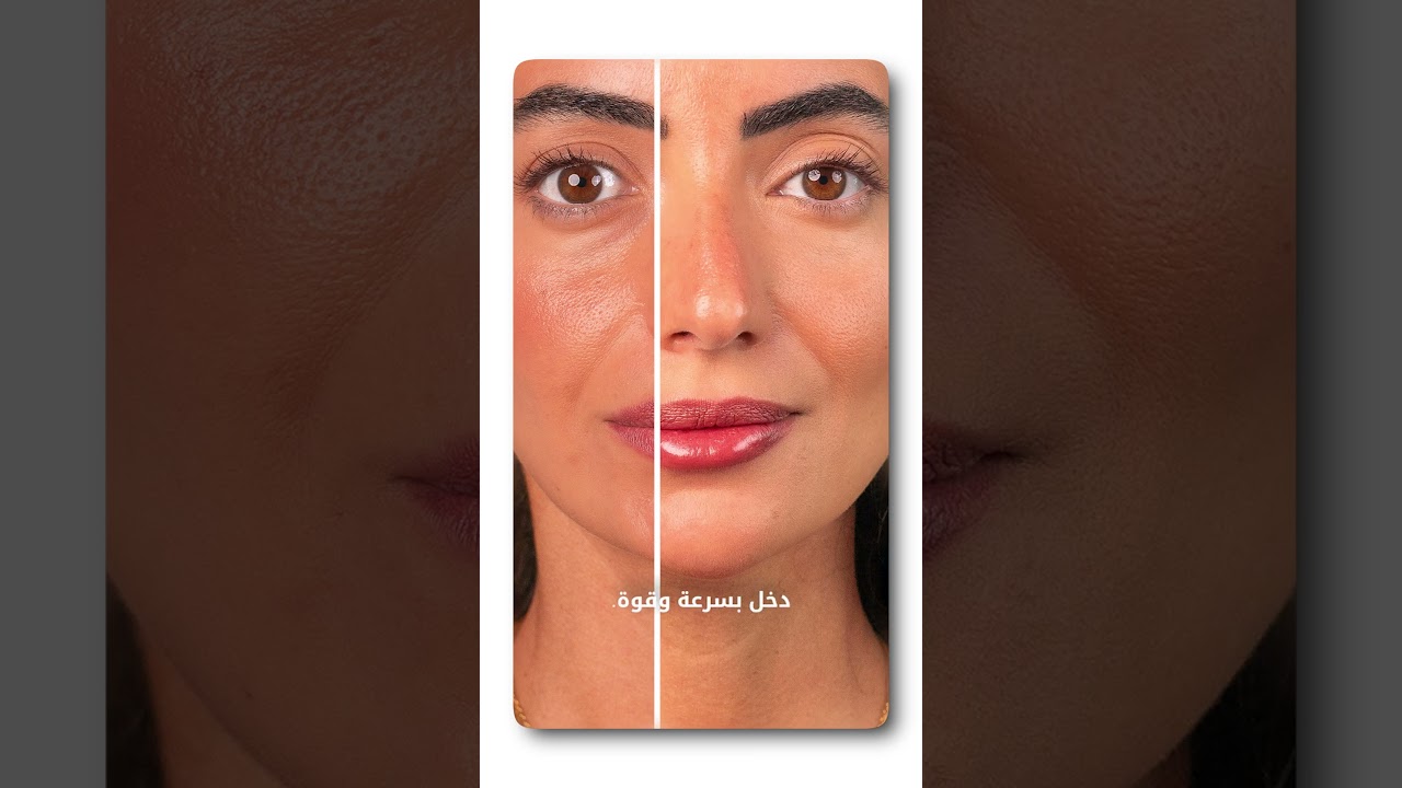 Fillers Dr Omar Al Khalili Clinic thumbnail