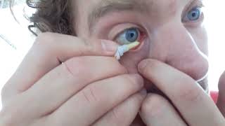 Ich tu mir Posiformin 2% ins Auge