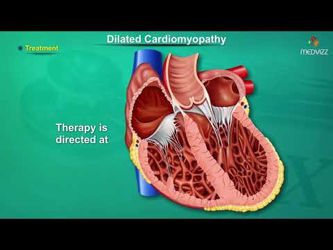 Dilated cardiomyopathy ( DCM ) : Causes, Signs and Symptoms, Pathogenesis, Diagnosis, and Treatment