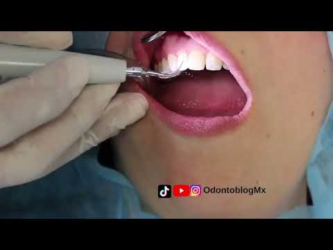 Limpieza dental con ultrasonido 🌟 🦷