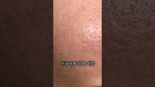 케미컬필 성형 시술
