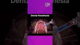 Dental Anesthesia #dentist #dental #dentalstudents #anesthesia #dentis