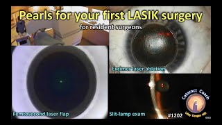 CataractCoach 1202: Pearls for your first LASIK surgery