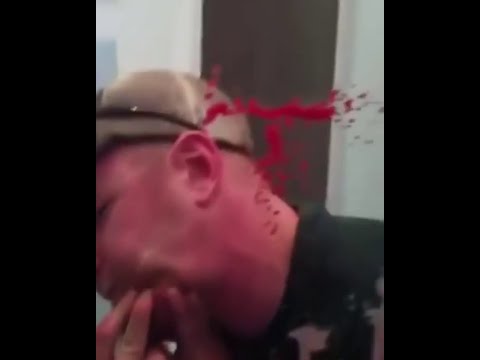 Чистка лица. Прыщи, угри и чёрные точки. Face cleaning. Pimples, blackheads, and black dots.