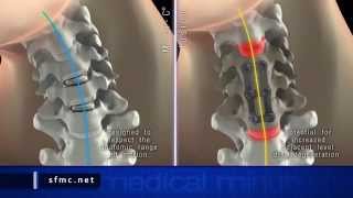 Medical Minute: Mobi-C Cervical Disc with Dr. Scott