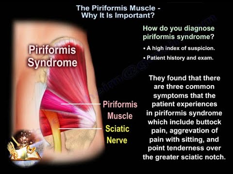 El síndrome de Piriformis causas y diagnóstico - Todo lo que se necesitas saber