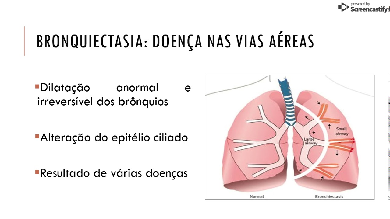Bronquiectasia