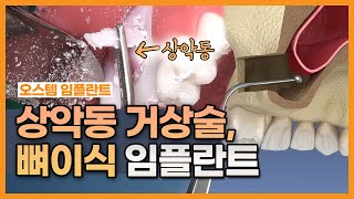 Sinus Lift Bone Graft