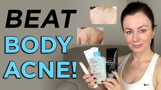 How to get rid of BODY ACNE: best products + top tips | Dr Sam Bunting