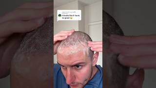 glad that’s over with #hair #hairtransformation #hairtransplant #update #washday #hairwashday #scab